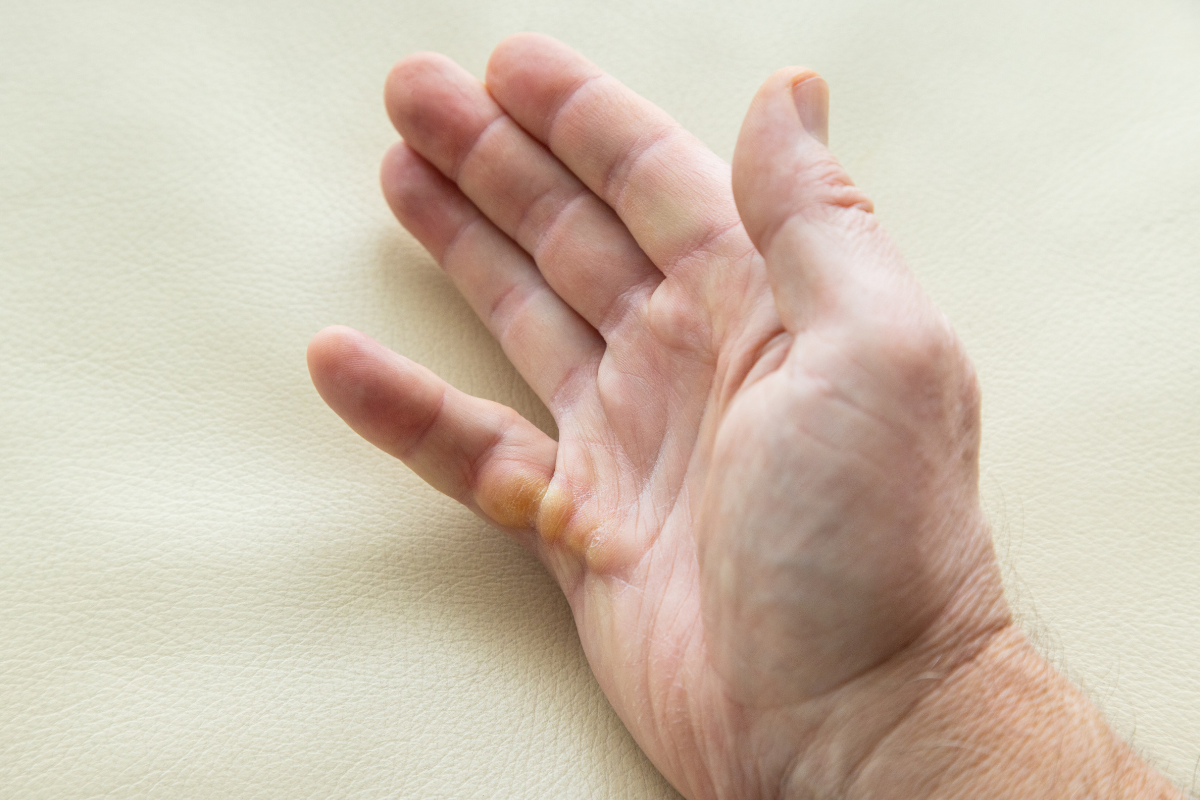 Dr Kuypers Kliniek Dupuytren