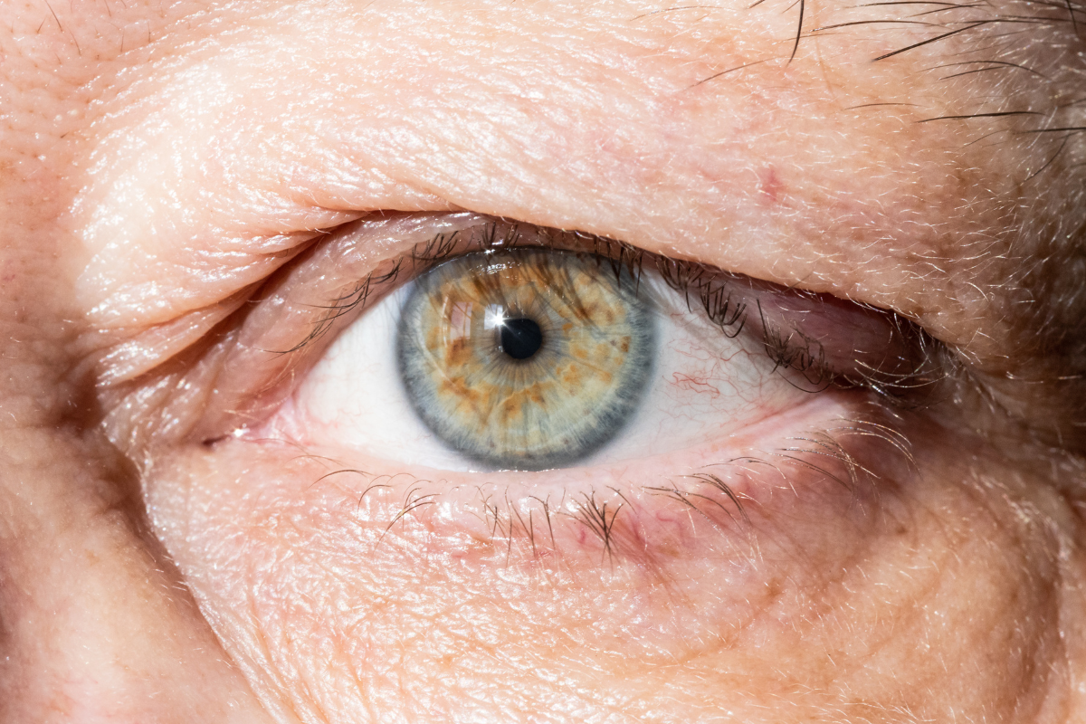 Dr Kuypers Kliniek Hangende Oogleden