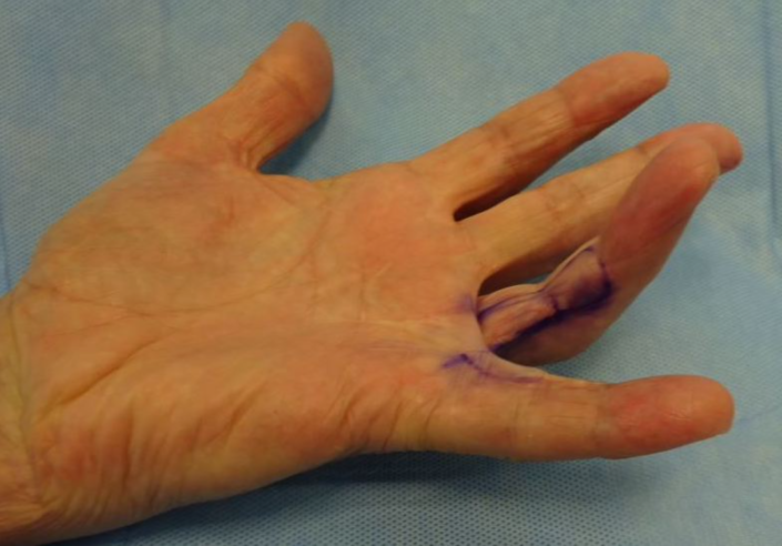 Kromme vinger tijdens eerste bezoek weer recht en na 2 dagen alles weer